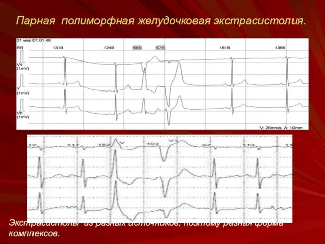 Парная полиморфная желудочковая экстрасистолия. Экстрасистолы из разных источников, поэтому разная форма комплексов.