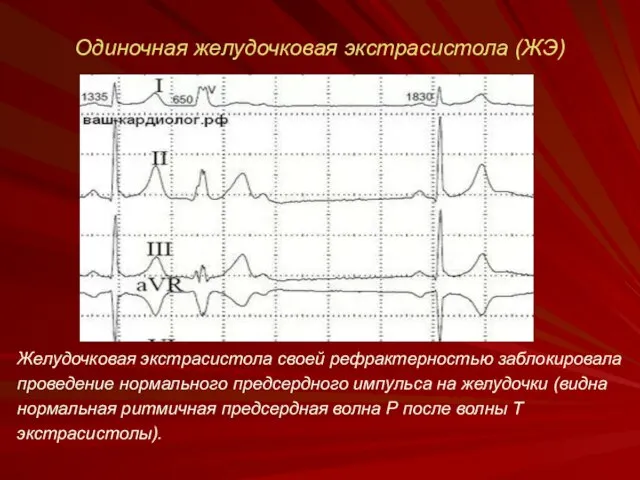 Одиночная желудочковая экстрасистола (ЖЭ) Желудочковая экстрасистола своей рефрактерностью заблокировала проведение нормального