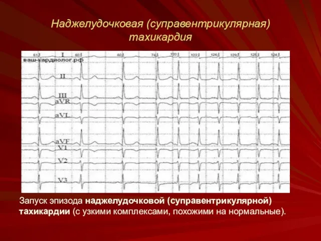 Наджелудочковая (суправентрикулярная) тахикардия Запуск эпизода наджелудочковой (суправентрикулярной) тахикардии (с узкими комплексами, похожими на нормальные).