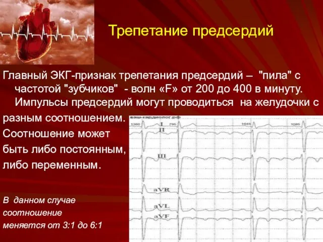 Трепетание предсердий Главный ЭКГ-признак трепетания предсердий – "пила" с частотой "зубчиков"