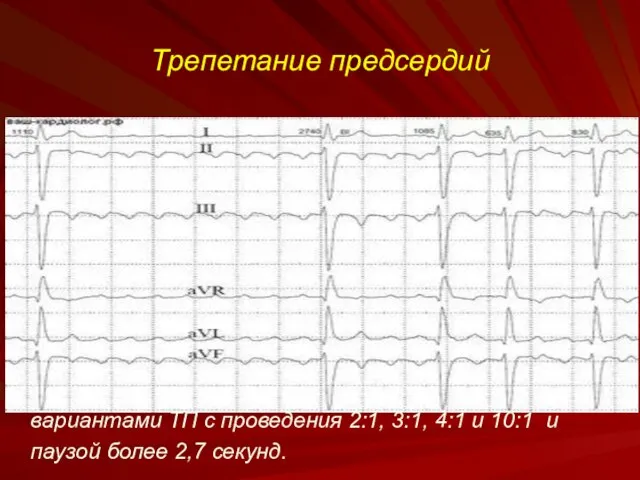 Трепетание предсердий вариантами ТП с проведения 2:1, 3:1, 4:1 и 10:1 и паузой более 2,7 секунд.