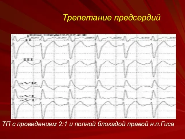 Трепетание предсердий ТП с проведением 2:1 и полной блокадой правой н.п.Гиса