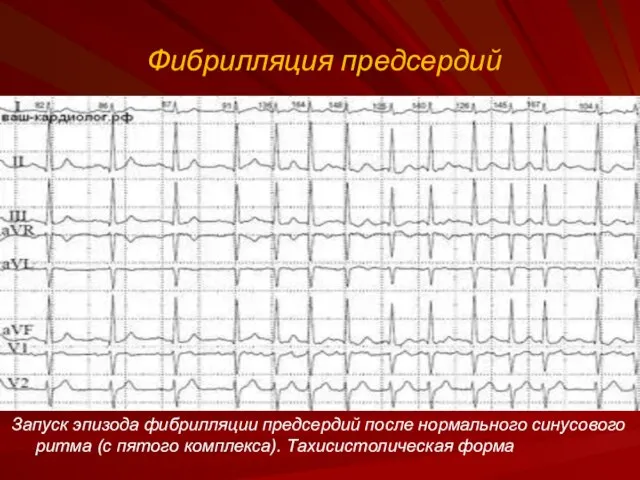 Фибрилляция предсердий Запуск эпизода фибрилляции предсердий после нормального синусового ритма (с пятого комплекса). Тахисистолическая форма