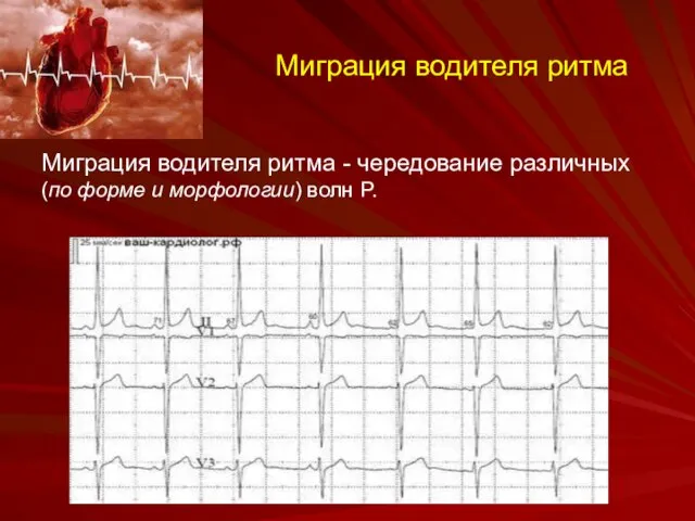 Миграция водителя ритма Миграция водителя ритма - чередование различных (по форме и морфологии) волн P.