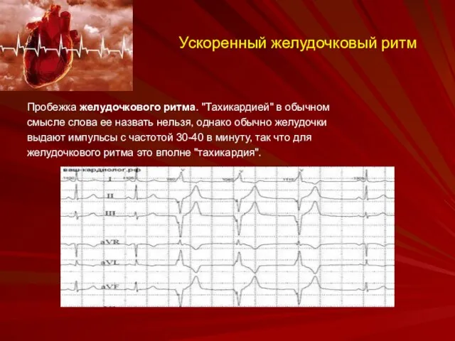 Ускоренный желудочковый ритм Пробежка желудочкового ритма. "Тахикардией" в обычном смысле слова