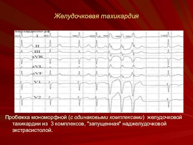 Желудочковая тахикардия Пробежка мономорфной (с одинаковыми комплексами) желудочковой тахикардии из 3 комплексов, "запущенная" наджелудочковой экстрасистолой.