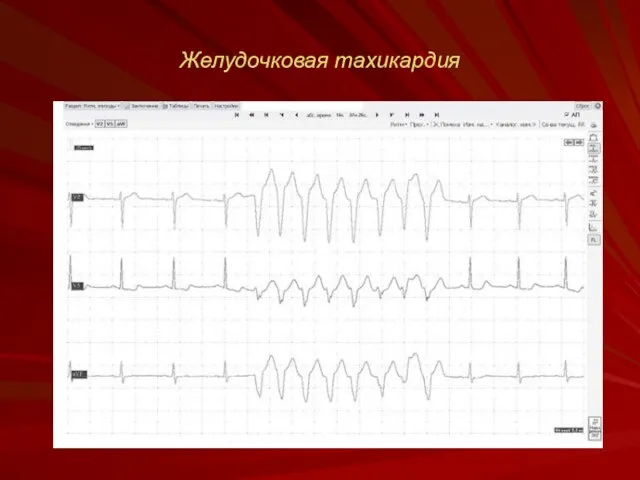 Желудочковая тахикардия