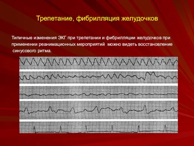 Трепетание, фибрилляция желудочков Типичные изменения ЭКГ при трепетании и фибрилляции желудочков