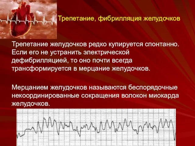 Трепетание, фибрилляция желудочков Трепетание желудочков редко купируется спонтанно. Если его не