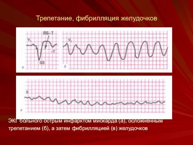 Трепетание, фибрилляция желудочков ЭКГ больного острым инфарктом миокарда (а), ос­ложненным трепетанием