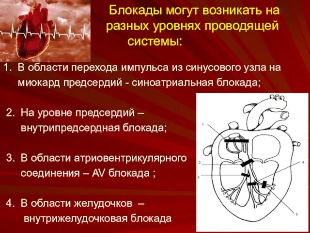 Блокады могут возникать на разных уровнях проводящей системы: 1. В области