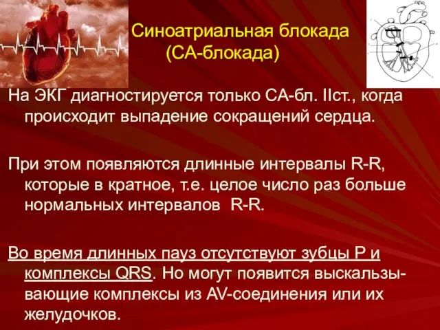 Синоатриальная блокада (СА-блокада) На ЭКГ диагностируется только СА-бл. IIст., когда происходит