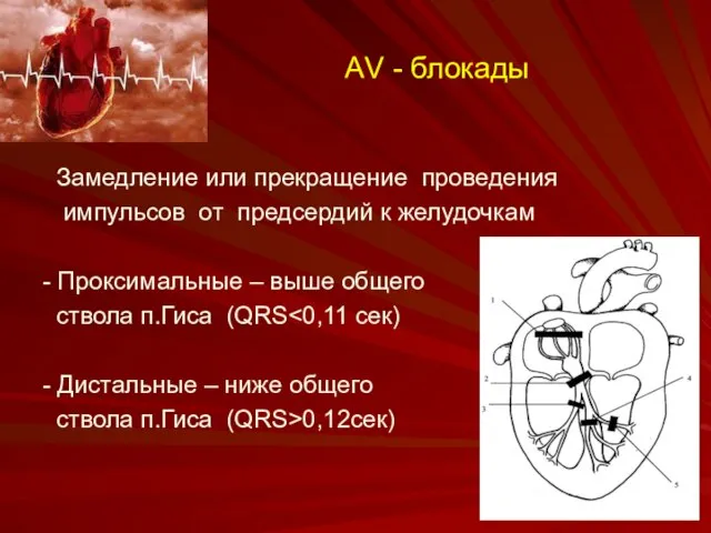 АV - блокады Замедление или прекращение проведения импульсов от предсердий к