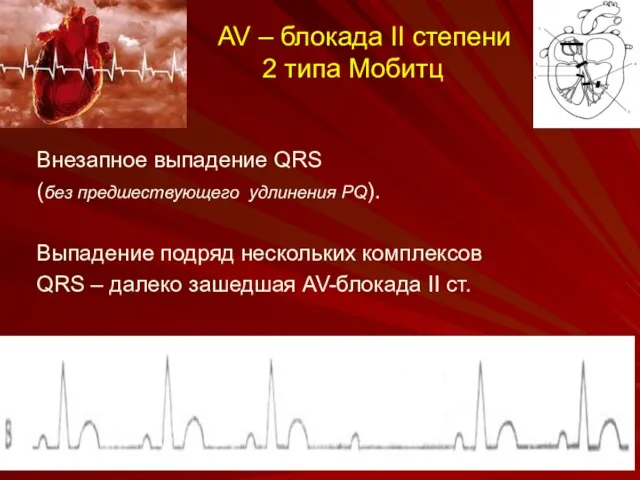 AV – блокада II степени 2 типа Мобитц Внезапное выпадение QRS