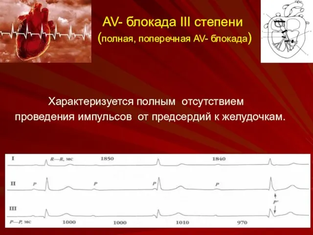 AV- блокада III степени (полная, поперечная AV- блокада) Характеризуется полным отсутствием