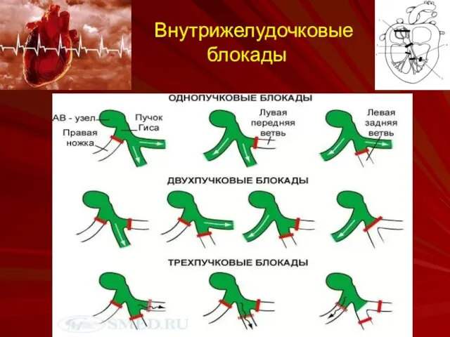 Внутрижелудочковые блокады