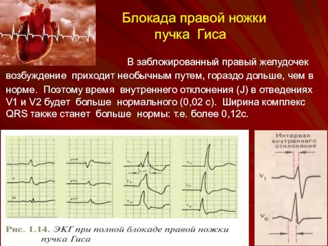 Блокада правой ножки пучка Гиса В заблокированный правый желудочек возбуждение приходит