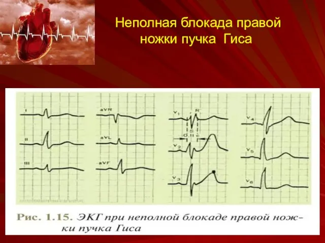 Неполная блокада правой ножки пучка Гиса