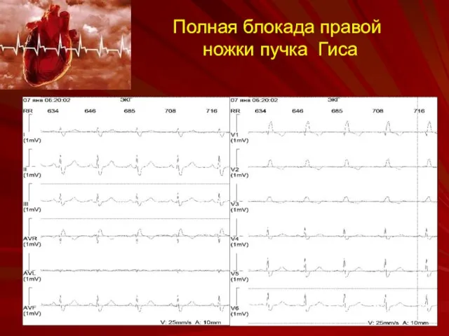 Полная блокада правой ножки пучка Гиса