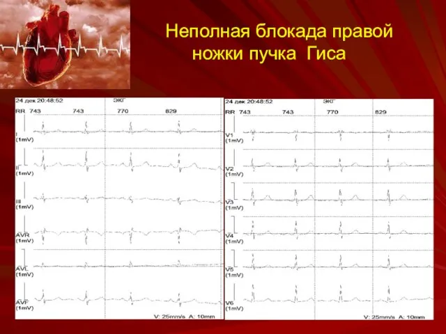 Неполная блокада правой ножки пучка Гиса