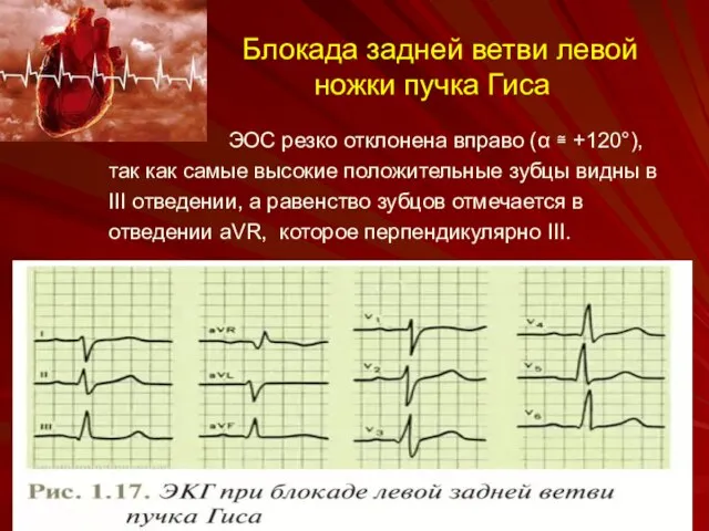 Блокада задней ветви левой ножки пучка Гиса ЭОС резко отклонена вправо