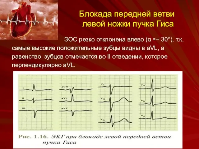 Блокада передней ветви левой ножки пучка Гиса ЭОС резко отклонена влево