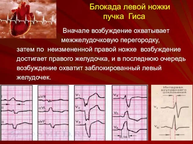 Блокада левой ножки пучка Гиса Вначале возбуждение охватывает межжелудочковую перегородку, затем