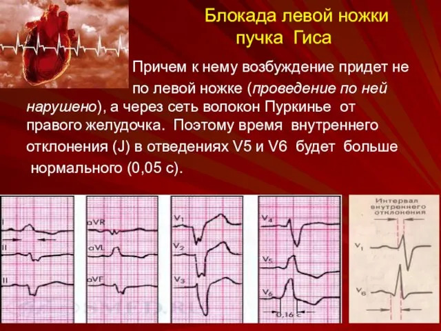 Блокада левой ножки пучка Гиса Причем к нему возбуждение придет не