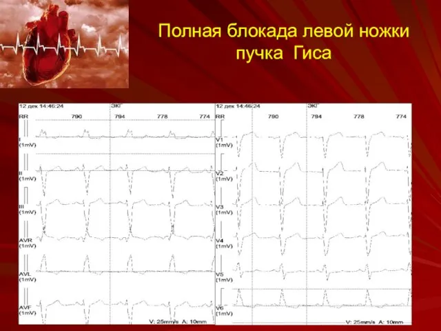 Полная блокада левой ножки пучка Гиса