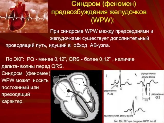 Синдром (феномен) предвозбуждения желудочков (WPW): При синдроме WPW между предсердиями и