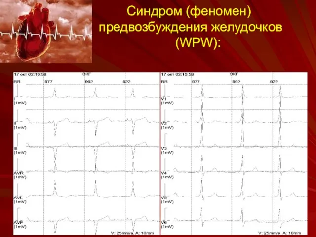 Синдром (феномен) предвозбуждения желудочков (WPW):