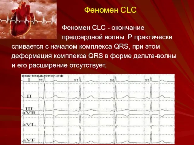 Феномен CLC Феномен CLC - окончание предсердной волны P практически сливается