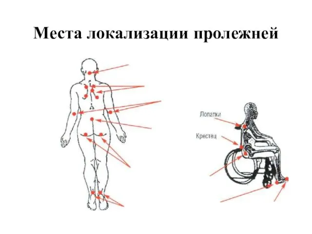 Места локализации пролежней