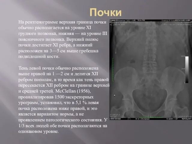 Почки На рентгенограмме верхняя граница почки обычно располагается на уровне XI