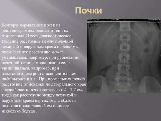 Почки Контуры нормальных почек на рентгенограммах ровные и тени их гомогенные.