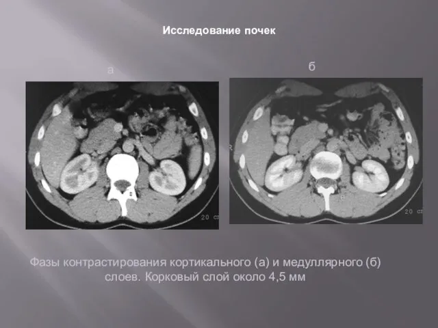 Исследование почек Фазы контрастирования кортикального (а) и медуллярного (б) слоев. Корковый