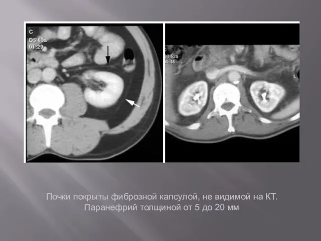 Почки покрыты фиброзной капсулой, не видимой на КТ. Паранефрий толщиной от 5 до 20 мм