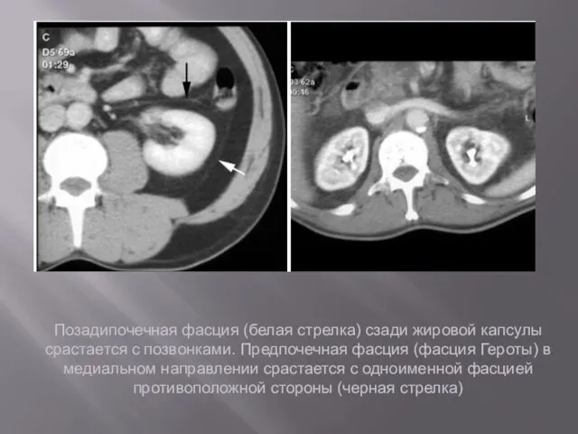 Позадипочечная фасция (белая стрелка) сзади жировой капсулы срастается с позвонками. Предпочечная