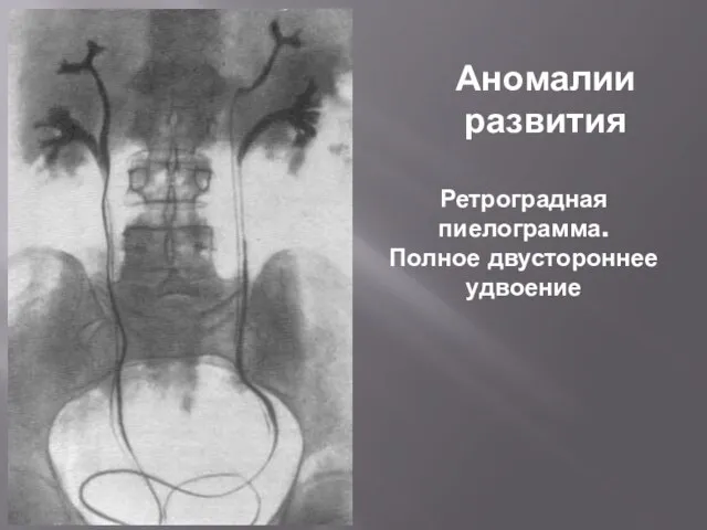 Ретроградная пиелограмма. Полное двустороннее удвоение Аномалии развития