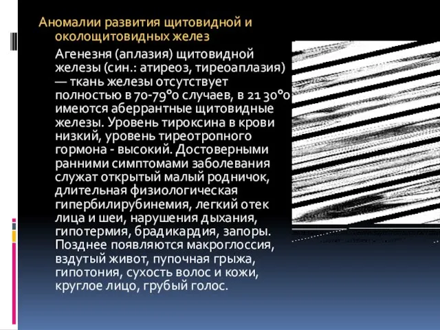 Аномалии развития щитовидной и околощитовидных желез Агенезня (аплазия) щитовидной железы (син.: