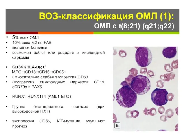 ВОЗ-классификация ОМЛ (1): ОМЛ с t(8;21) (q21;q22) 5% всех ОМЛ 10%