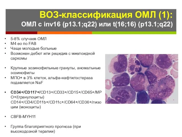 ВОЗ-классификация ОМЛ (1): ОМЛ с inv16 (p13.1;q22) или t(16;16) (p13.1;q22) 5-8%