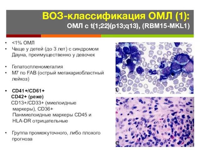 ВОЗ-классификация ОМЛ (1): ОМЛ с t(1;22)(p13;q13), (RBM15-MKL1) Чаще у детей (до