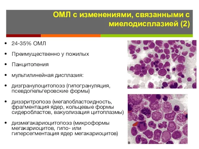 ОМЛ с изменениями, связанными с миелодисплазией (2) 24-35% ОМЛ Преимущественно у