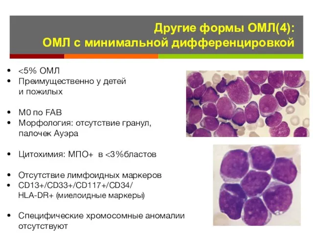 Другие формы ОМЛ(4): ОМЛ с минимальной дифференцировкой Преимущественно у детей и