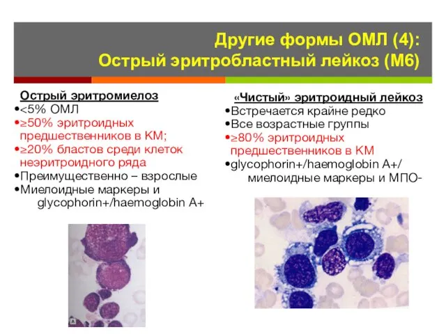 Другие формы ОМЛ (4): Острый эритробластный лейкоз (М6) Острый эритромиелоз ≥50%