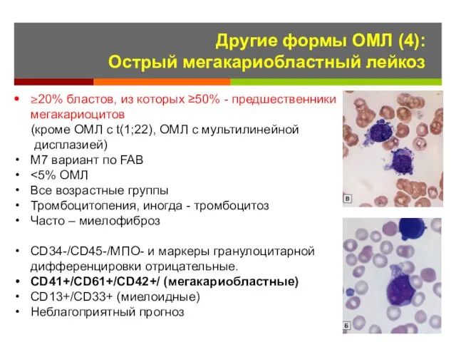 Другие формы ОМЛ (4): Острый мегакариобластный лейкоз ≥20% бластов, из которых