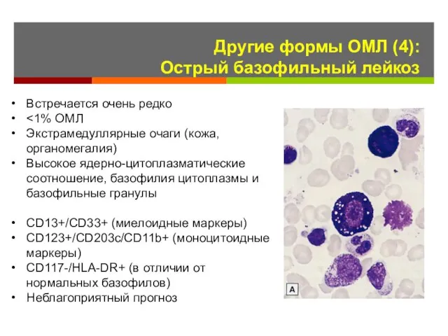 Другие формы ОМЛ (4): Острый базофильный лейкоз Встречается очень редко Экстрамедуллярные