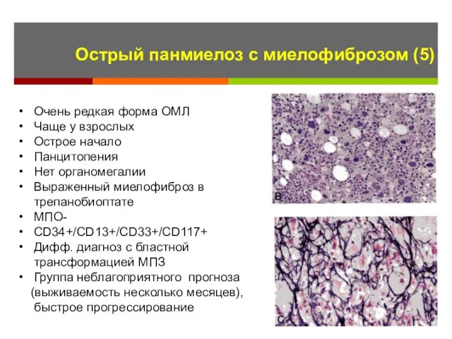 Острый панмиелоз с миелофиброзом (5) Очень редкая форма ОМЛ Чаще у