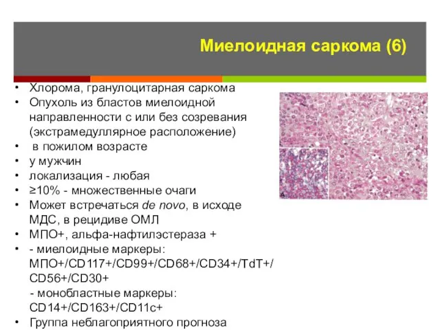 Миелоидная саркома (6) Хлорома, гранулоцитарная саркома Опухоль из бластов миелоидной направленности